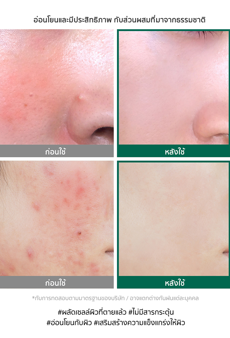 เซรั่ม Some by Mi AHA BHA PHA 30 Days Miracle Serum 50 ml รักษาสิวใน 30 วัน ช่วยบำรุงผิวหน้า สำหรับผู้ที่เป็นสิว ผิวมัน รูขุมขนกว้าง