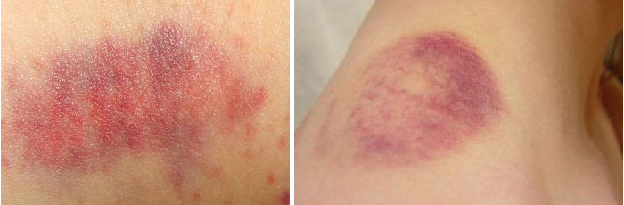 ภาวะเกล็ดเลือดต่ำ