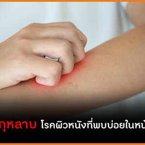 👉หน้าฝนต้องระวัง โรคผื่นกุหลาบ เป็นตอนท้องอันตราย !!!